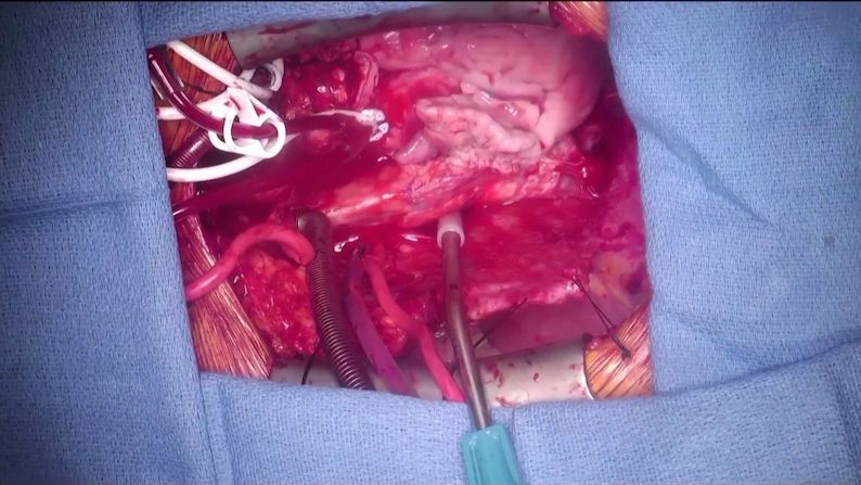 Lékaři transplantovali muži srdce prasete